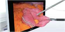 High-definition screen with 3D image of laparoscopic instruments manipulating tissue coming out of screen